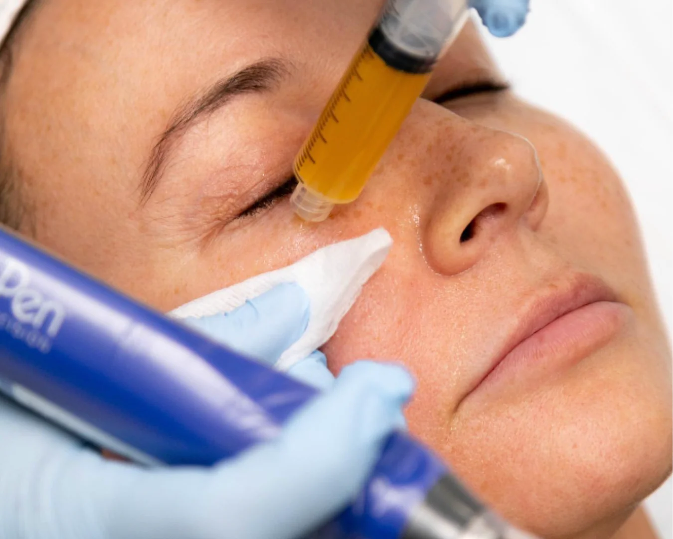 SkinPen with PRP